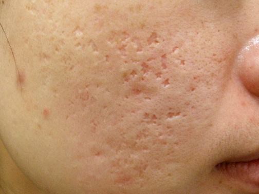 最新痘坑撫平神器，科技重塑肌膚之美，自信生活從此開始