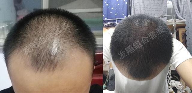 治愈脫發(fā)最新重大突破，重塑自信，希望之光再現