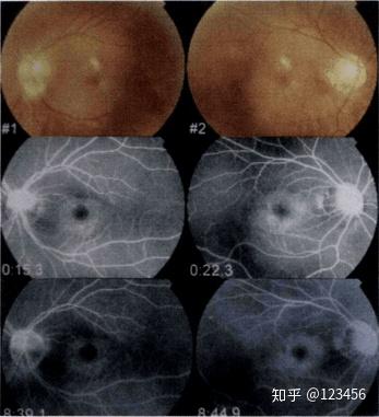 最新藥肺炎詳解，你需要知道的一切——健康小紅書